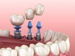 3,Tooth,Crowns,Placement,Over,3,Implants, ,Concept.,3d