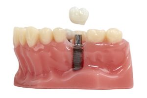 Cost Of Single Tooth Implants procedure