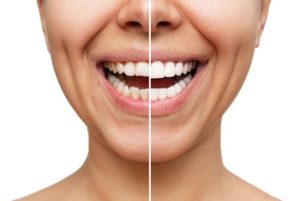 Do Veneers Fall Off before and after