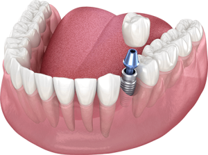 Single Tooth Implants