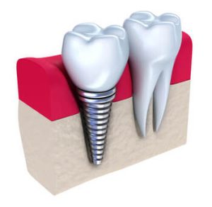 dental implant payment plans illustration