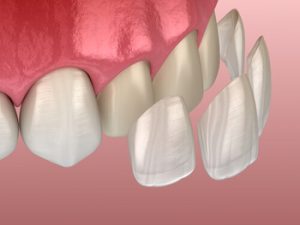 dentist for veneers application