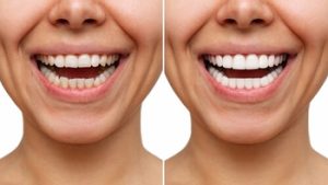 how to care for veneers before and after