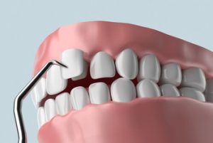 Full Set Of Veneers Cost Turkey procedure