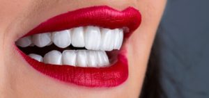 Full Set Of Veneers Cost Turkey results