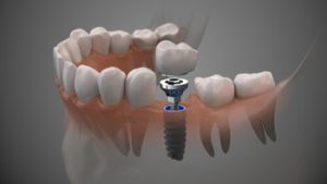 Dental Implants Price Comparison procedure