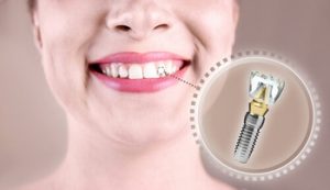 Cost Of Bone Grafting For Dental Implants In Australia before