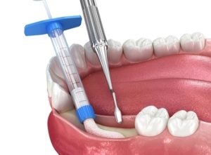 Bone,Grafting,,Augmentation.,Medically,Accurate,3d,Illustration.