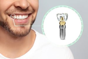 Dental Implants Pattaya illustration