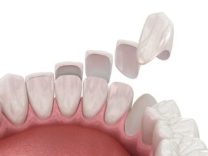 Do Veneers Help with Sensitive Teeth illustration