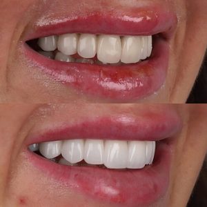 What Happens When You Get Veneers before after