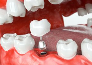 dental implant price bangkok parts