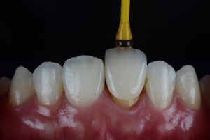 How Are Veneers Fitted procedure