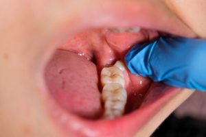 Infected Wisdom Tooth symptoms