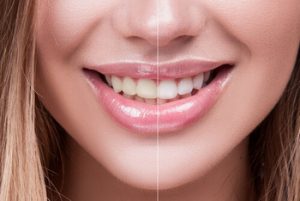 professional teeth whitening before after