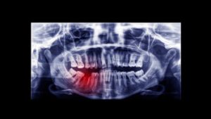 Root Canal Recovery Time benefits