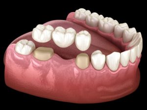 Before and After Dental Bridge fit