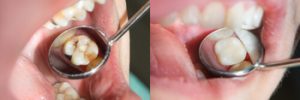 Before and After Wisdom Teeth Removal fix
