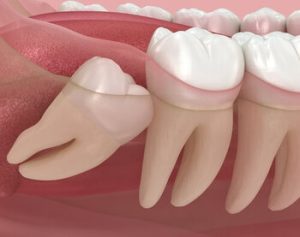 Benefits of Keeping Wisdom Teeth impacted