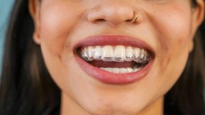 Is Invisalign Worth It wear