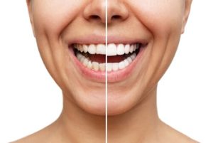 How to Whiten Teeth with Braces images