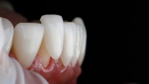 Porcelain Veneers Procedure application