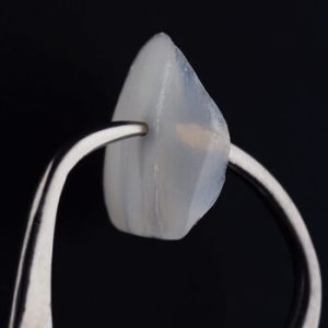 Porcelain Veneers Procedure shell