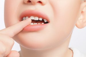 Tooth Decay in Children symptoms