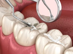 Molar,Tooth,Fissure,Restoration,With,Filling.,Medically,Accurate,Tooth,3d