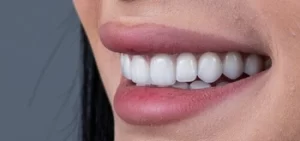 Teeth Whitening on Veneers no need