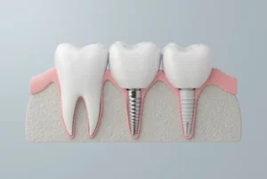 how to relieve pain from dental implant procedure
