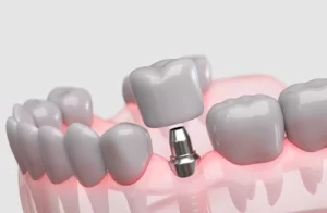 Dental Implant Healing Stages application