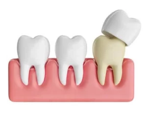 What Do Teeth Look Like Under crown What Do Teeth Look Like Under crown