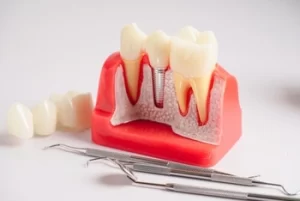 symptoms of loose dental implant crown procedure
