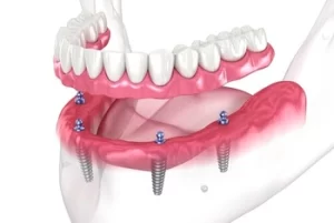 Implant Retained Dentures or full arch implants