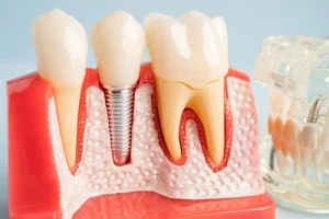 Dental Bone Graft Recovery implant