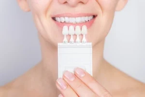What Do Veneers Do colour